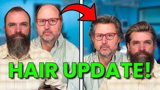 The Truth About Hair Transplants (One Year Update)