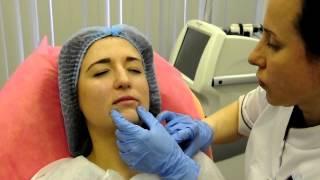 Увеличение губ. Косметолог Арбекова О.А. Atribeaute Clinique
