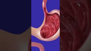 Hiatal Hernia  Quick Facts!!! #hiatalhernia #hernia #stomach #diaphragm #viralshorts2025 #viralvideo