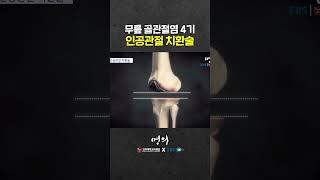 무릎 인공관절 수술은 어떻게 할까?