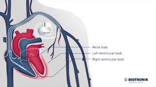 Cardiac Resynchronization Therapy – How it works