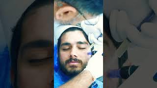 facial PRP with meso  #skincare #aesthetic #beautiful #hydrafacial