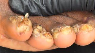 Rehema Teye's big clear jiggers #1 -- watch long videos @riseupsociety.net & @ruskenya.org
