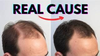 The Truth about what REALLY causes Hair Loss - Male Pattern Baldness Explained!