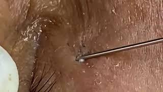 VÍDEO DE CRAVOS E ESPINHAS GIGANTES