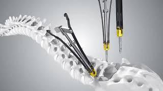 Sanyou Medical: Zita MIS Bone Cement Screw system