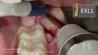 PIEZOSURGERY - Dr. Jason Motta - Piezoelectric approach for wisdom teeth extraction