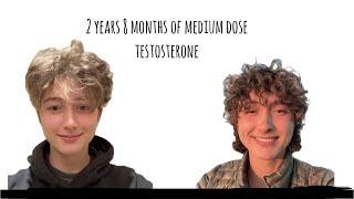 Non Binary HRT Journey: Over 2.5 Years on "Medium" Dose Testosterone