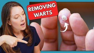 Best Wart Treatments | Dr. Hannah Kopelman