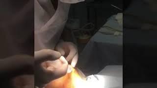 Buxaq plastikasi(liposaksiya) ile Ayaz Mammadov