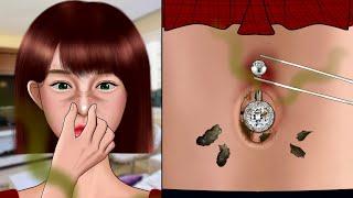 ASMR Satisfying navel stone removal animation‼️ Removing Pus from Piercing, Piercing Cleaning