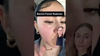 Natural Rosacea Relief That Actually Works #dermatologist