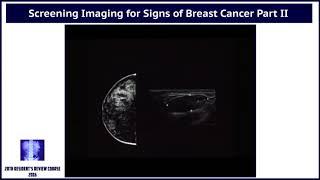 Screening Imaging for Signs of Breast Cancer - Part II