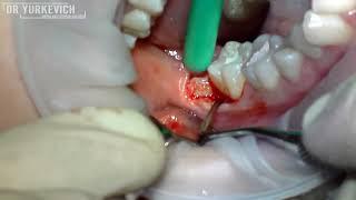 Удаление полуретенированных зубов мудрости. Wisdom teeth extraction