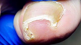 Super Curly Ingrown Nails, Silky Trimming~【Pedicure Master Lin Jun】