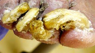 The Old Man's Toenails Became Twisted, So They Were Carefully Trimmed[Doctor Liu Pedicure]