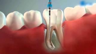 эндодонтия. лечение каналов зуба. гуттаперча. 3д- пломбирование.