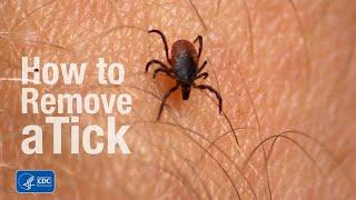 How to remove a tick