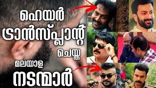 ഹെയർ ട്രാൻസ്പ്ലാന്റ് ചെയ്ത മലയാള നടന്മാർ | Hair Transplant | Hair Transplant malayalam