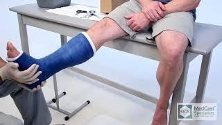 Short Leg Cast - Easy - With Cast Removal