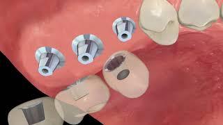 Dental Implant Cost - Bethesda, MD - Dr. Robert Schlossberg