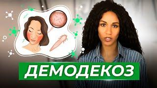 ДЕМОДЕКС // ДЕМОДЕКОЗ: как и чем лечить?