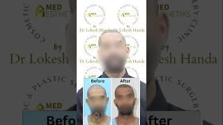 Hair Transplant Patient Testimonial | Hair Transplant Review | Best Hair Transplant Surgeon in Delhi