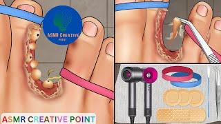 ASMR Treatment athlete's foot and warts between toes at home | Deep cleaning | Foot care animation