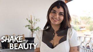 I'm 80% Covered In Birthmarks | SHAKE MY BEAUTY