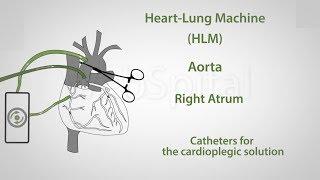 Coronary artery bypass surgery with the heart lung mashine