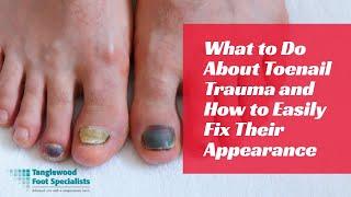 What to Do About Toenail Trauma and How to Easily Fix Their Appearance