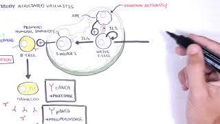 ANCA Associated Vasculitis (Anti-Neutrophil Cytoplasmic Antibody) - Causes, Pathophysiology, Types