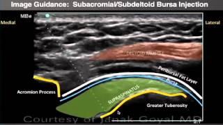 Webinar: Ultrasound-Guided Shoulder Injections Part 1