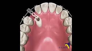 Canine Impaction #dentist#bracing #orthodontics#canine_impaction#Impaction#Exposure#Canine_exposure