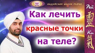 Как лечить красные точки на теле? - Харприт Сингх Хира