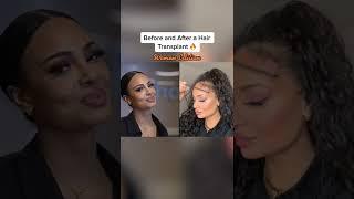 Before After a Hair Transplant at Elithair | Women's Edition #shorts