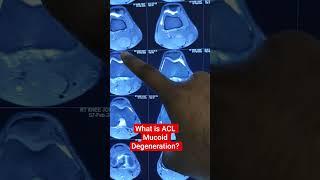 What is ACL Mucoid Degeneration?  Dr Sai Chandra MBBS DNB Ortho Hyderabad