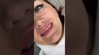 Композитные виниры. Реставрация зубов. Дзерасса Гуссоева.