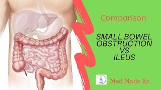 SBO vs Ileus | What is the difference?