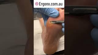 Thick callus cut from foot by podiatrist in podiatry clinic