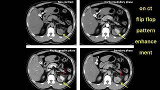 ONCOCYTOMA ON EACH MODALITY