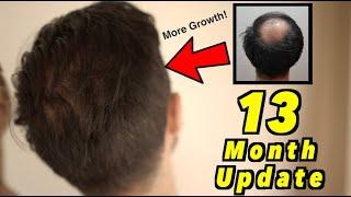 13 Month 2nd Hair Transplant Update | 4000 GRAFTS FUE | ITS WORKING