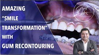 Cosmetic Gum Surgery | Smile Transformation | Cosmetic Dental Treatment |  Before and After Results