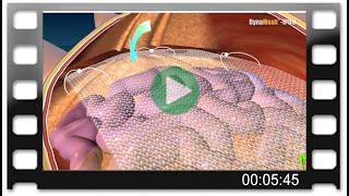 DynaMesh®-IPOM - Animation: Laparoscopic Repair of Incisional Hernia