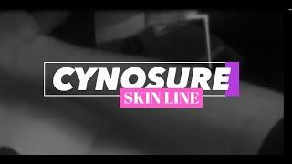 Cynosure Alexandrite laser for hair removal at Skin Line