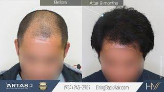 Hair By Dr. Max, Restoration Center: Before and After Results with ARTAS iX Hair Transplant