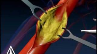 Carotid Endarectomy - 3D Medical Animation