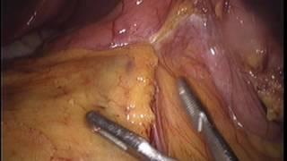 Sleeve Gastrectomy with omentopexy by Wael Tobar MD