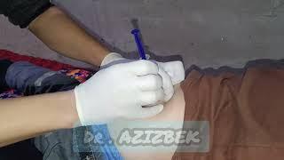 injection into the gluteal muscle. intramuscular injection #injection #intramuscular #intramuscular