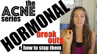 Hormonal Acne - Stop the Monthly Breakouts! The Acne Series